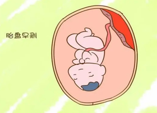 胚胎早剥就是胎盘早剥