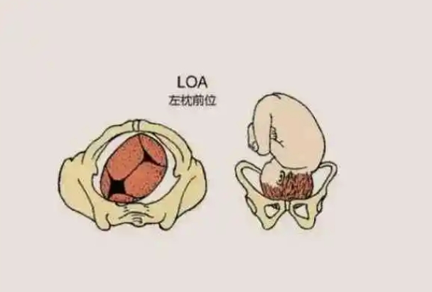 loa胎位可以顺产