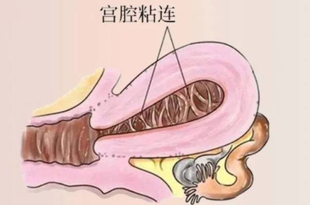 宫腔粘连手术费用清单，后期治疗才是重中之重