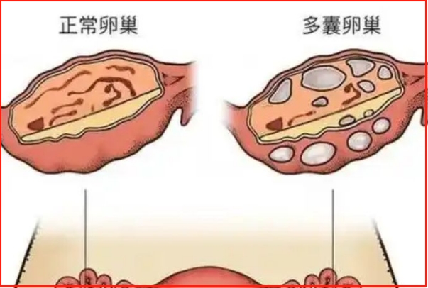 多囊患者可以进行促排卵治疗