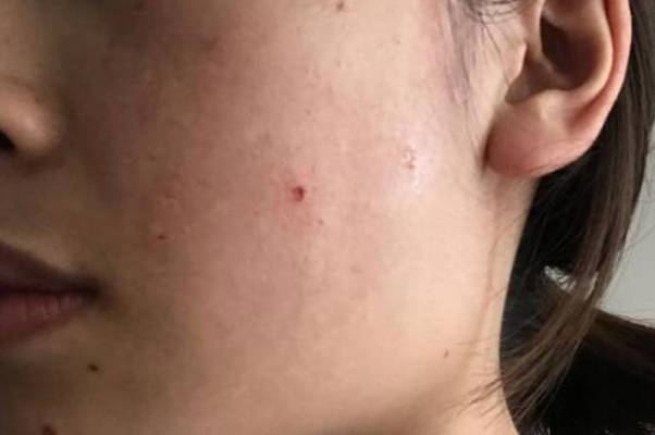 盘点女性怀孕前三个月最准怀男孩的征兆，皮肤变差是其一