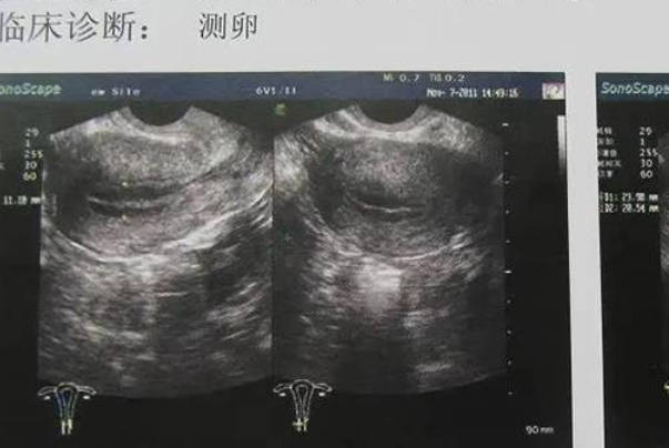 孕5月B超数据预测胎儿性别：网络付费解读的准确性与科学探讨