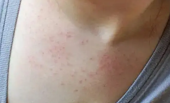 孕妇检查发现风疹病毒抗体igg和igm阳性有什么区别？
