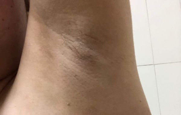 怀孕25周腋下变黑有一道道纹是男孩还是女孩呢？