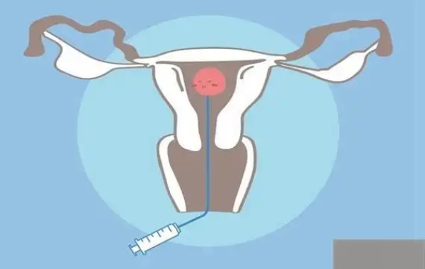 29岁女性刮了子宫内膜最快多久可以做三代试管呢？