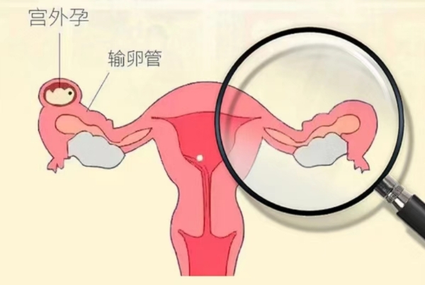 输卵一侧通畅还是有机会自然怀孕