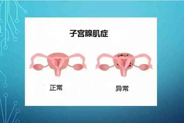 子宫腺肌症对受孕几率影响较大