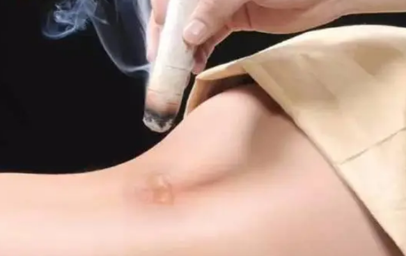 艾灸能促进血液循环
