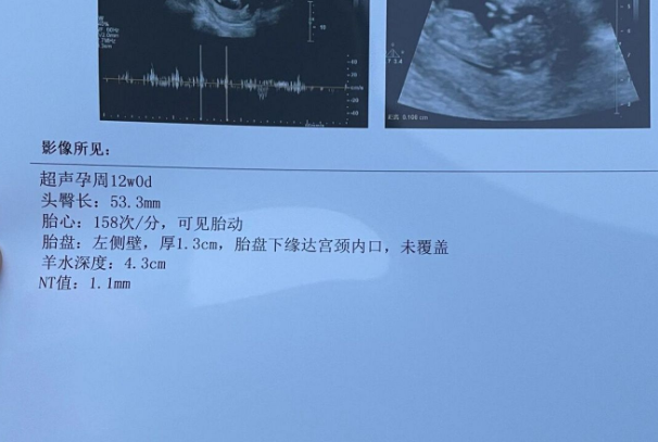 高龄孕妇nt值2.8mm一定会生个畸形宝宝吗？