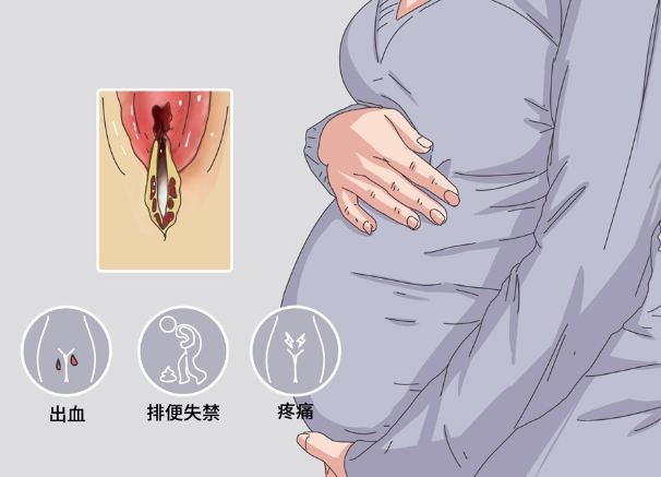 Ⅰ度撕裂出血不多