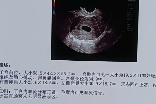 有人能分享怀孕初期通过孕囊形状看男女(超准)的方法吗？
