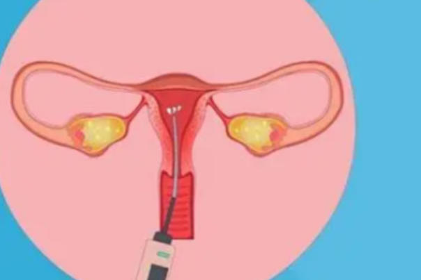 胚胎质量会影响着床成功率