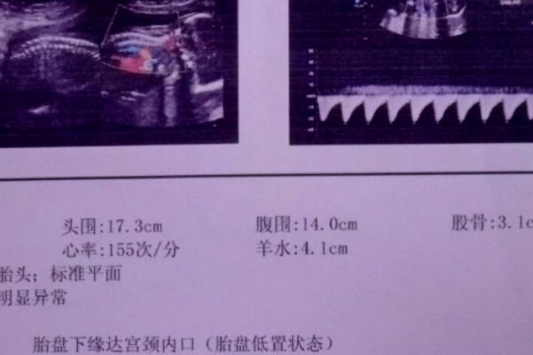 网传可以通过孕20周b超单上孕囊形状看男女是真的吗？