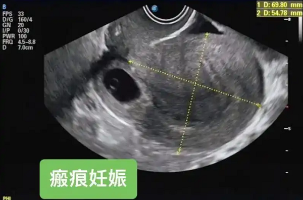 疤痕妊娠后半年可以通过三代试管婴儿要小孩吗?