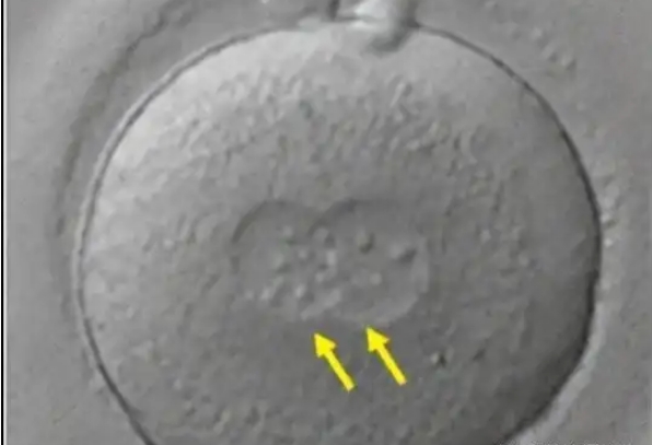0pn囊胚移植最后胎儿畸形，染色体异常提高了风险