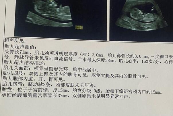 高龄孕妇12周检查出nt值2.5mm处于临界点该怎么办？