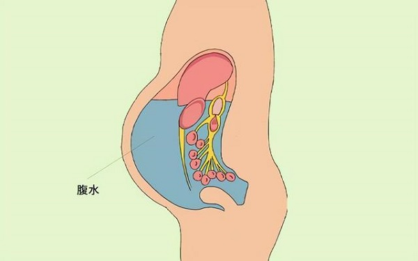 取出卵子后会有腹水的情况