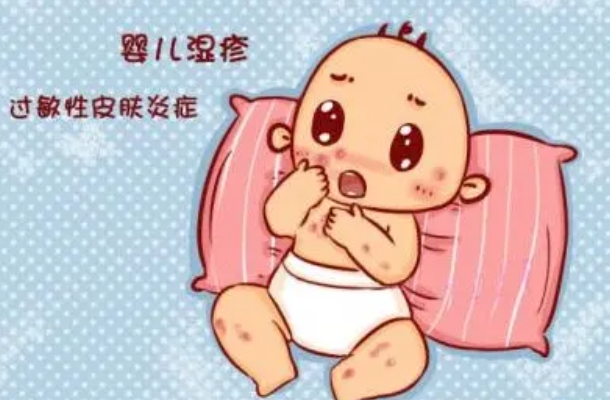 婴儿湿疹要及时治疗