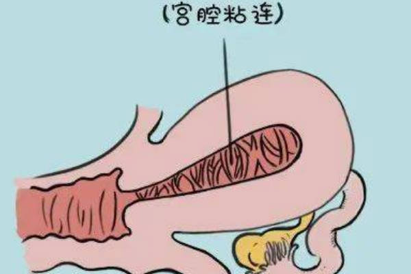 宫腔粘连的病因90%与妊娠有关
