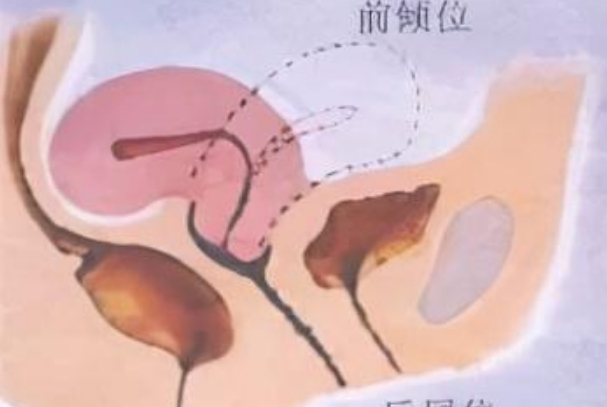 子宫前位女性备孕攻略，同房后平躺还是垫枕头哪个更科学
