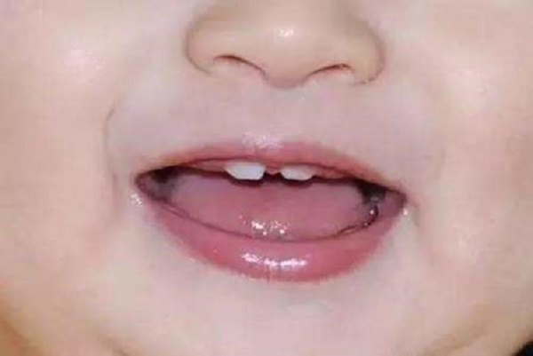 3个月婴儿长牙太快的危害分享，会口腔不适、难以入睡