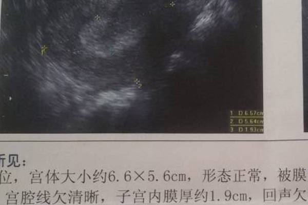 内膜17mm回声不均匀别大意，出现这三种问题不适合移植