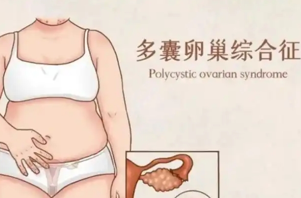 非典型和典型多囊综合征谁对女性而言更加严重一点呢?