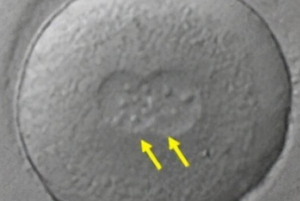 为什么移植1个胚胎却怀上双胞胎？揭秘试管婴儿中的意外惊喜