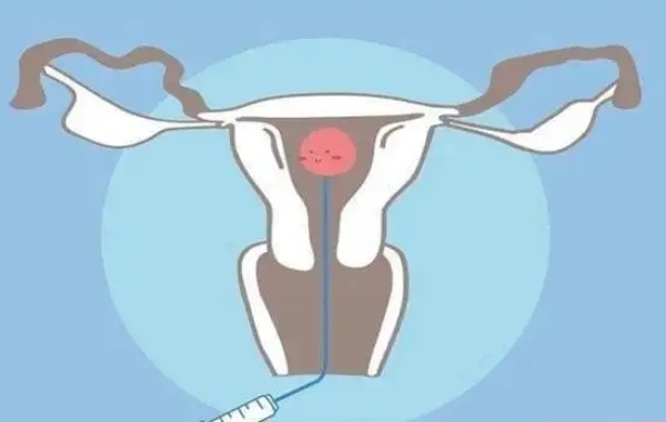 38岁多囊女性做三代试管移植一个还是两个胚胎好呢？