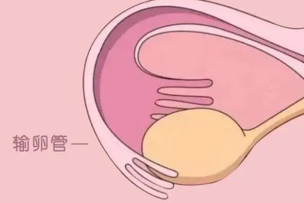 输卵管严重堵塞会导致不孕