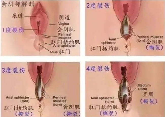 有人能分享一下顺产撕裂一度到4度图吗？