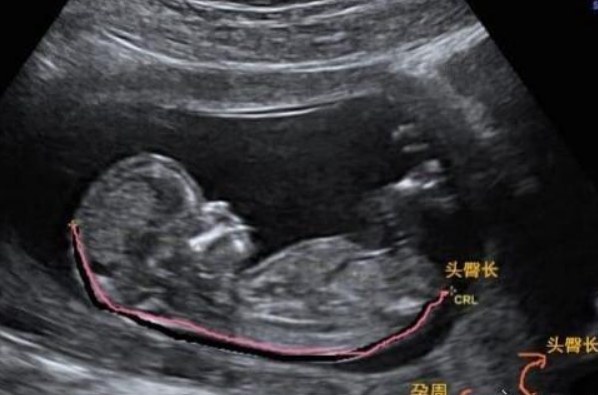 孕6周头臀长约有3mm