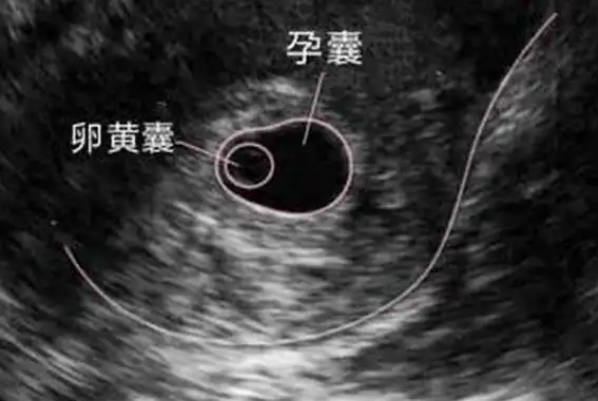 医生说B超有卵黄囊就没事，内附不同孕周卵黄囊大小标准