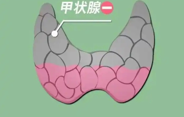女性甲减数值3.5能直接做三代试管吗？