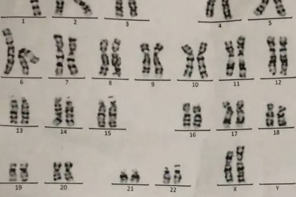 染色体少一条能不能生育，比夫妻染色体不合更严重？