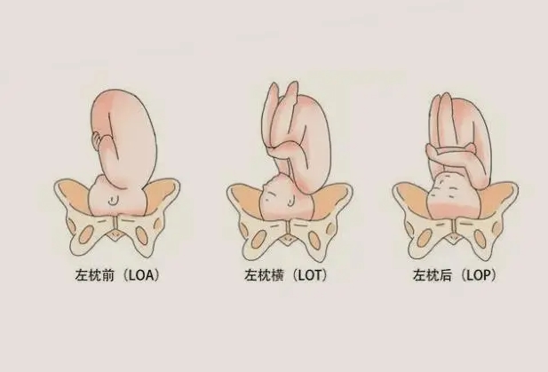 有loa胎位在肚子里的图片分享一下吗？