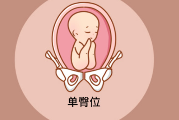 臀位是异常胎儿之一