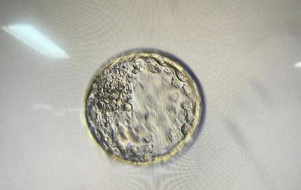 囊胚移植后雌激素水平增高会刺激乳腺腺管