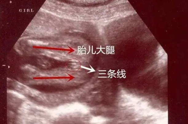 通过B超可以判断胎儿是男是女