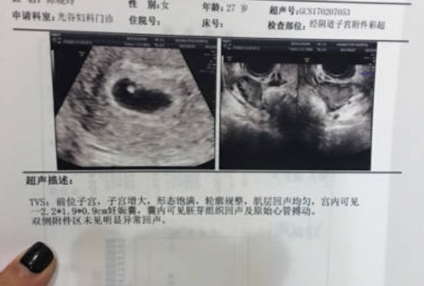 孕20天胎儿只有2-3毫米长