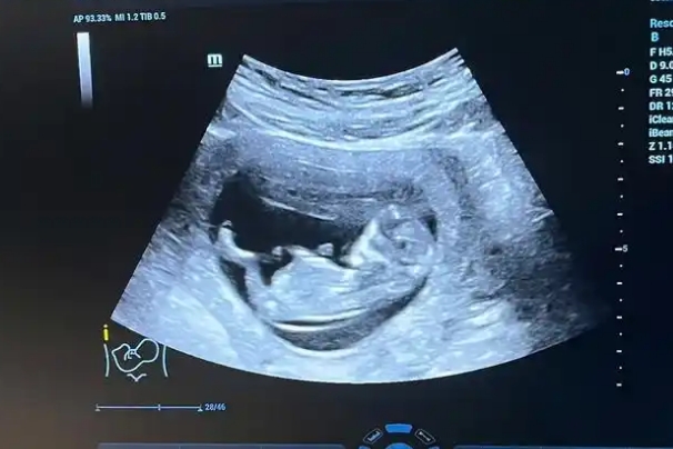 妊娠糖尿病孕妇nt容易不过