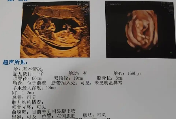 孕12周怎么从NT单上看出胎儿是男娃娃还是女娃娃呢？
