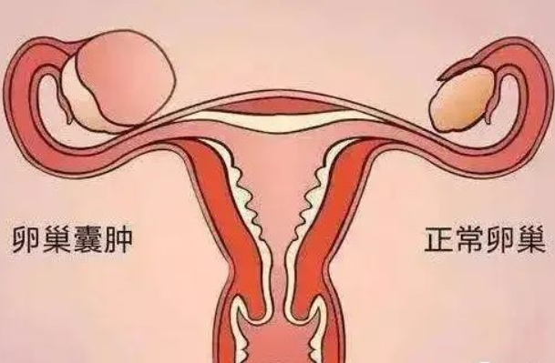 卵巢囊肿分为生理性和病理性