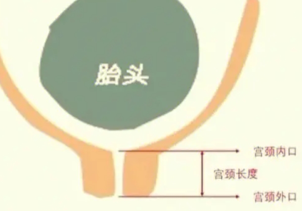 孕晚期宫颈口短到什么程度就代表宝宝要发动了？