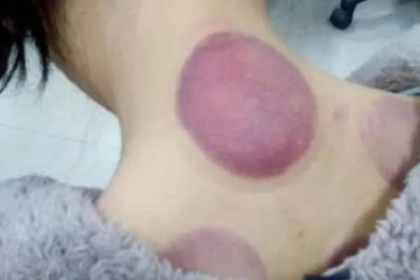 刮痧拔罐的四大禁忌总结，特别是取卵之后千万别碰
