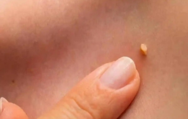 女方hpv阳性可以做一代试管移植2个胚胎吗？