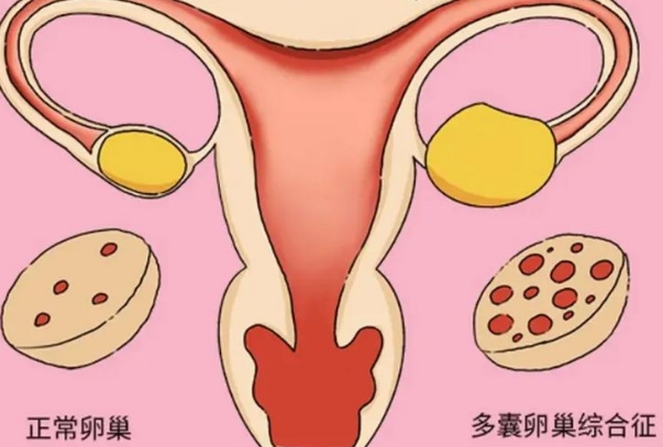 多囊卵巢综合征患者备孕成功经验，科学调理有助孕效果