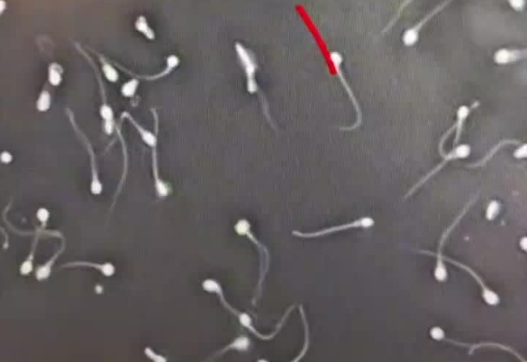 男方精子的碎片率达到17.46%可以直接备孕吗？