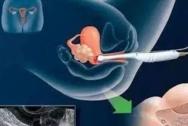 试管促排后人工取卵的全部过程是什么样子？