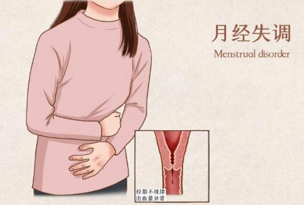子宫腺肌症会引起进行性加重痛经